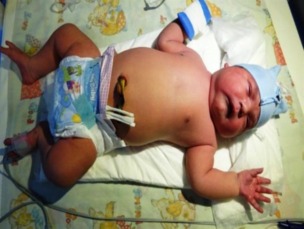 تولد نوزاد ۶ کیلویی در میاندوآب